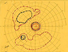 Visual field, OS, in 1987 demonstrates further loss of peripheral visual field. 