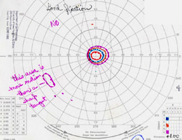 Visual field, OS, in 1997 demonstrates complete loss of peripheral field with preserved central visual field. 