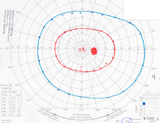 Visual field, OD, in 1997. All fields in the right eye remained completely normal over the course of care. 