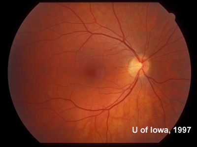 Sixty degree view of the posterior fundus, right eye, more than twenty years after onset of symptoms in the left eye.