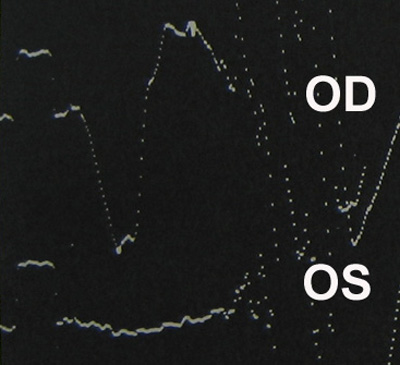 Photopic ERG. Amplitude is normal in the right eye (OD) and extinguished in the left eye (OS).