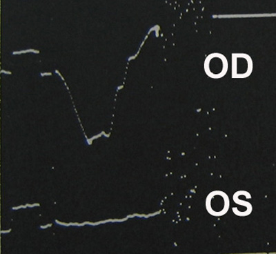 Scotopic ERG. Amplitude is normal in the right eye (OD) and extinguished in the left eye (OS).