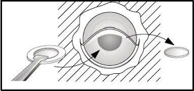 Diagram of stage I insertion of keratoprosthesis
