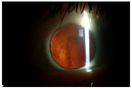 Slit lamp view of patient in video with red reflex showing resolution of RPM.