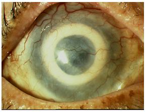 Just prior to Stage II surgery