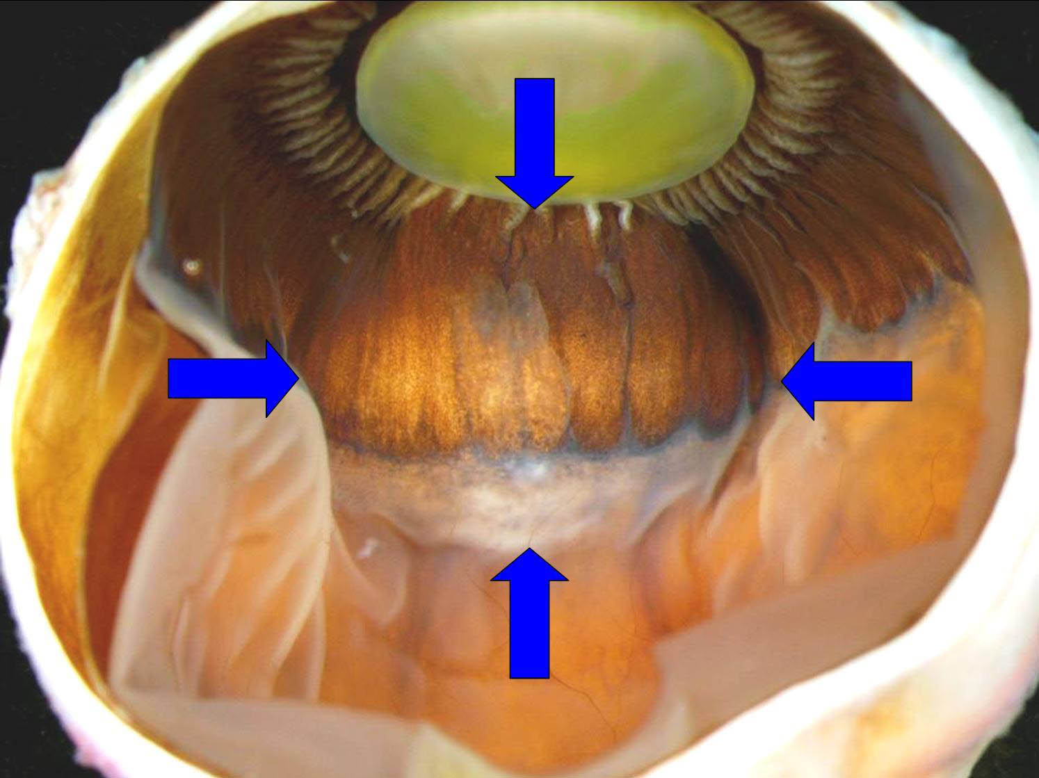 Clinicopathologic Correlation: Ciliary Body Leiomyoma. EyeRounds.org