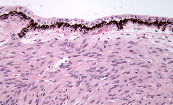 Ciliary body leiomyoma: mass lesions of the choroid and ciliary body 