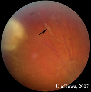 Thick peri-arteriolar Kyrieleis plaques are evident (arrow) on vessels near the active Toxoplasmosis lesion. 