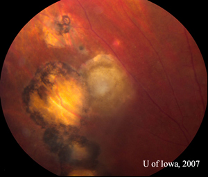 Closer view of the toxoplasmic lesion, OS, after six weeks of therapy. The previously active lesion appears to be involuting into a pigmented scar. Perivascular infiltrates have resolved