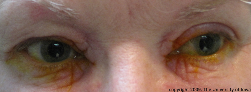 A close up of a person's eye with an obvious astigmatism.