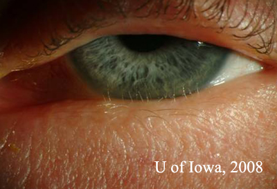 Distichiasis. slit lamp. left eye