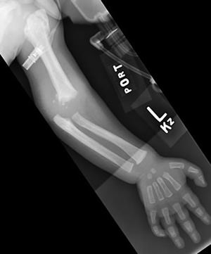 Left humerus fracture, shaken baby, non-accidental trauma case