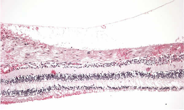 Histology, subretinal, intraretinal, and preretinal hemorrhage