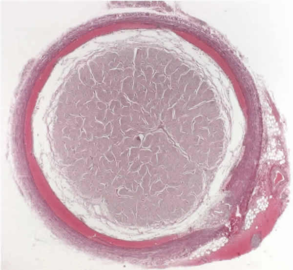 Subdural and extradural optic nerve sheath hemorrhage