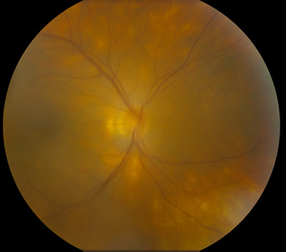 Fundus photo. Birdshot choroidopathy