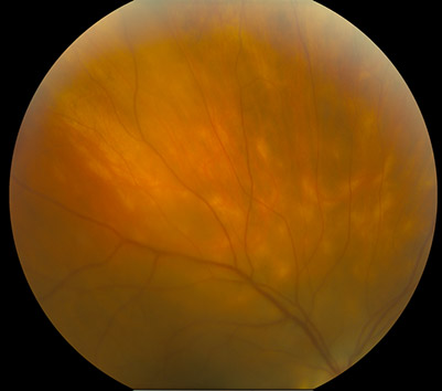 Fundus photo. Birdshot choroidopathy