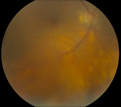 Fundus photo. Birdshot choroidopathy