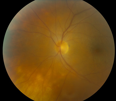 Fundus photo. Birdshot choroidopathy