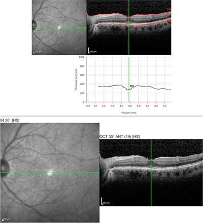 Optical Coherence Tomography, Birdshot Choroidopathy