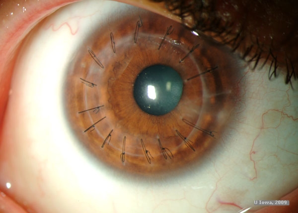 Surgical Management of Keratoconus - DALK - Deep anterior lamellar keratoplasty