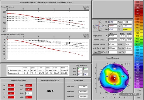 Surgical Management of Keratoconus