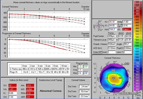 Surgical Management of Keratoconus