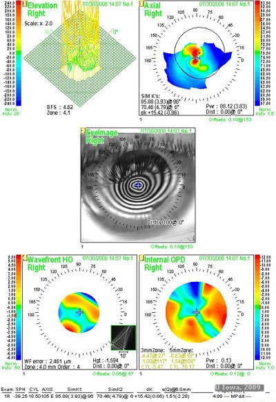 Surgical Management of Keratoconus