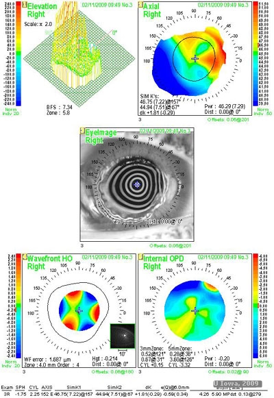 Surgical Management of Keratoconus