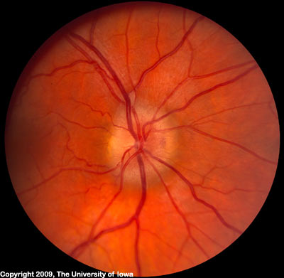 optic disc edema