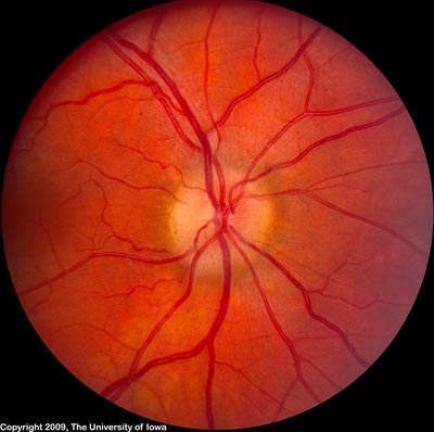 Improved Optic disc edema