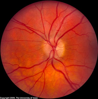 Optic disc edema improved