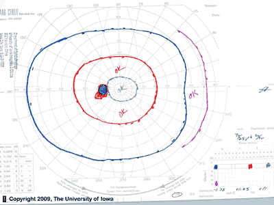 Goldmann Visual Field