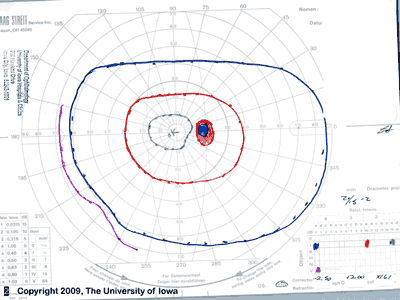 Goldmann Visual Field