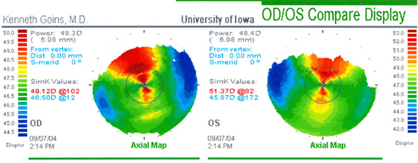 corneal topographies