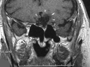 MRI