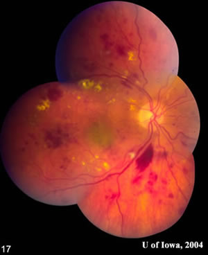 Right Eye - Fundus