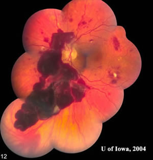 Left Eye - Fundus