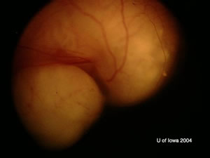 Retinoblastoma