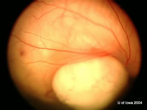 Retinoblastoma