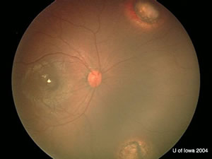 Retinoblastoma