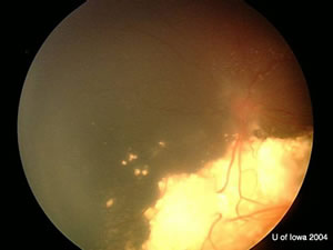 Retinoblastoma