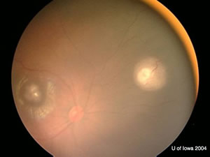 Retinoblastoma