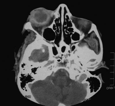 Axial CT