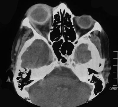 Axial CT