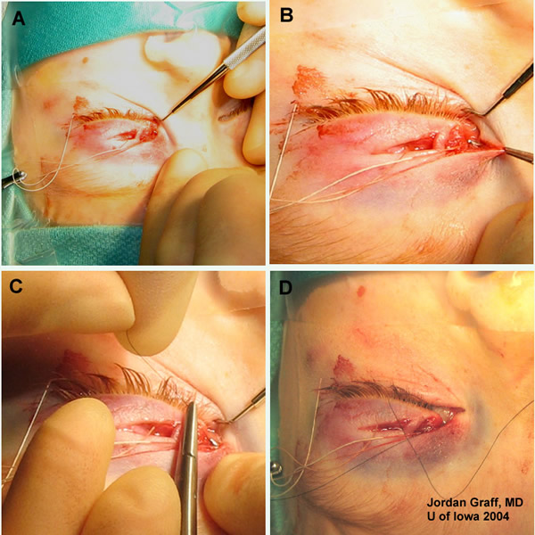 pigtail probe in canalicular repair