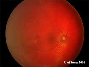 Choroidal hemangioma