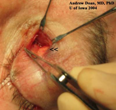 Anterior Orbitotomy