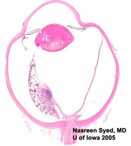 Retinoblastoma