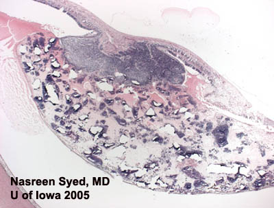 Retinoblastoma