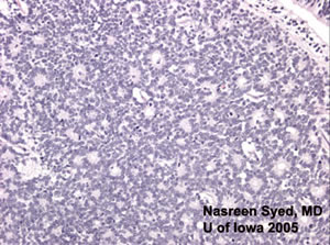 Retinoblastoma